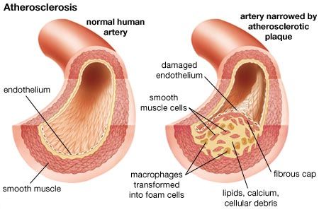 Arteriosclerotic-Cardiovascular-Disease