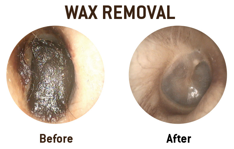 ear wax removal